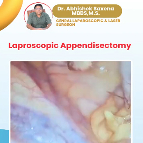 Laparoscopic-Appendectomy-thumbnail