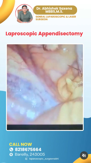 Laparoscopic-Appendectomy