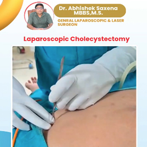 Laparoscopic-Cholecystectomy-thumbnail