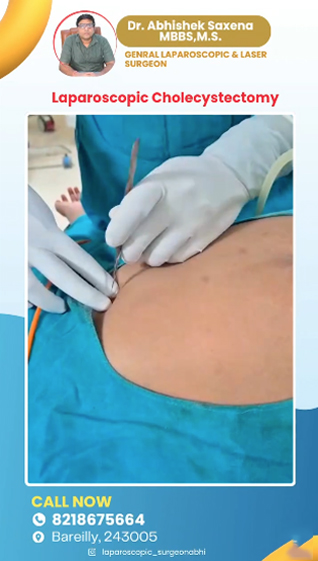 Laparoscopic-Cholecystectomy