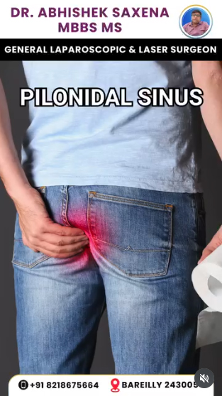 Relief-from-Pilonidal-Sinus-Effects